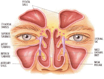 Inflammation des sinus frontaux (sinusite)